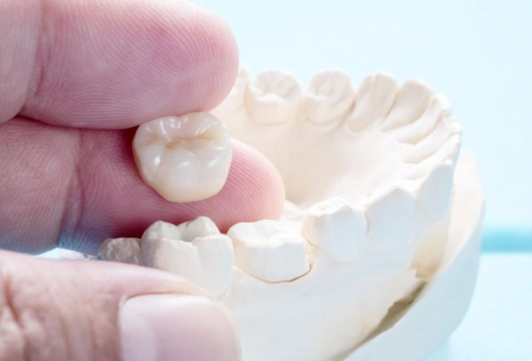 Verificación del ajuste de una corona dental en un modelo dental