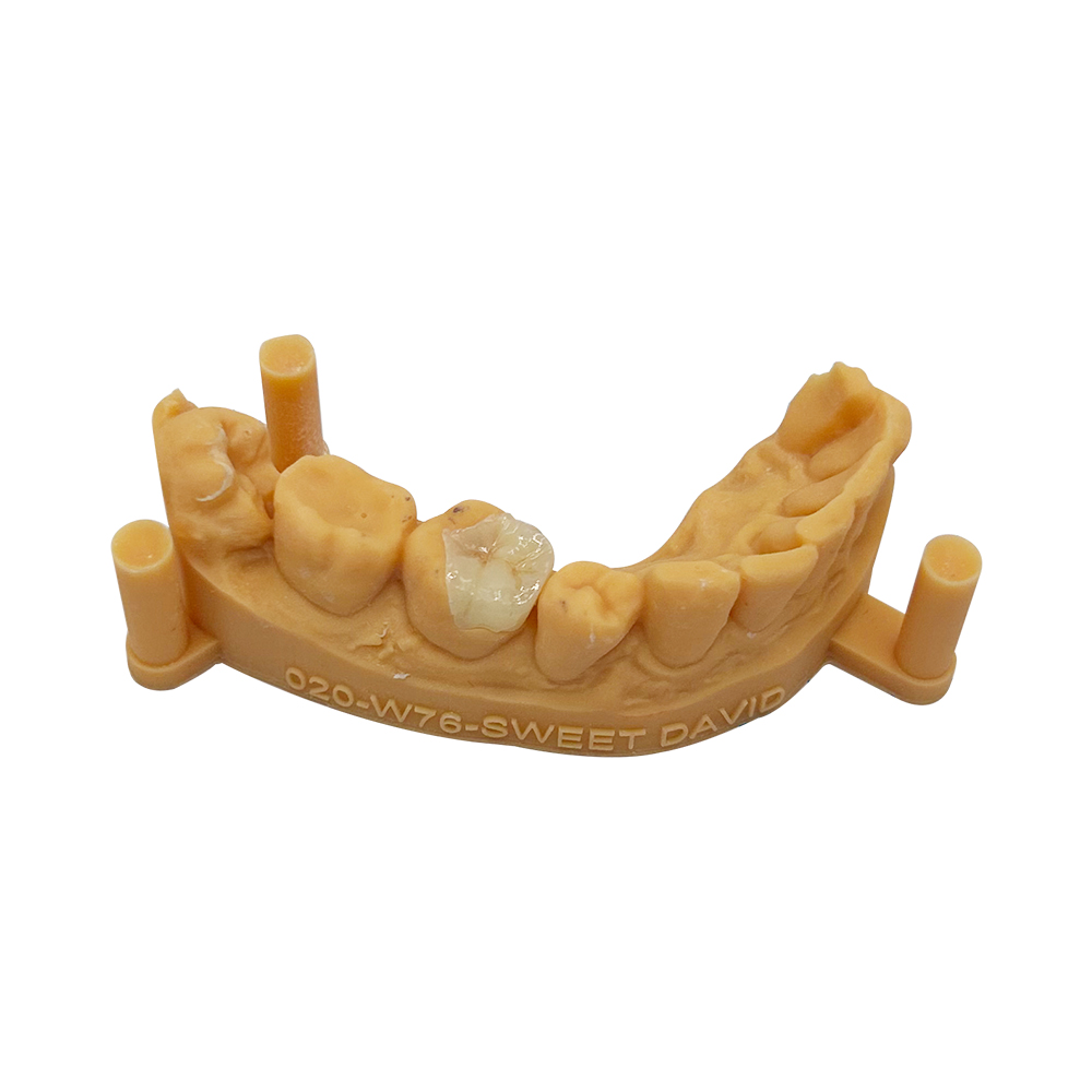 Modelo dental de arcada completa para planificación de restauración sobre implantes