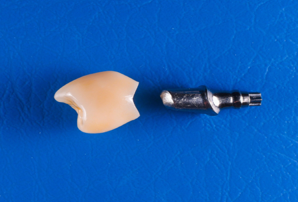 Dental implant crown with abutment component