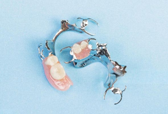 Estructura metálica para restauraciones de porcelana fundida sobre metal