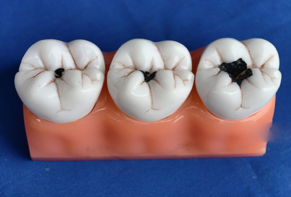 Finished zirconia molar crowns